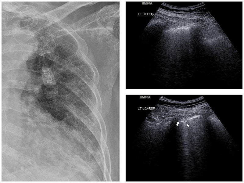 Рентгенография и УЗИ пациентки 75 лет с пневмонией и подтвержденным диагнозом COVID-19 (b)