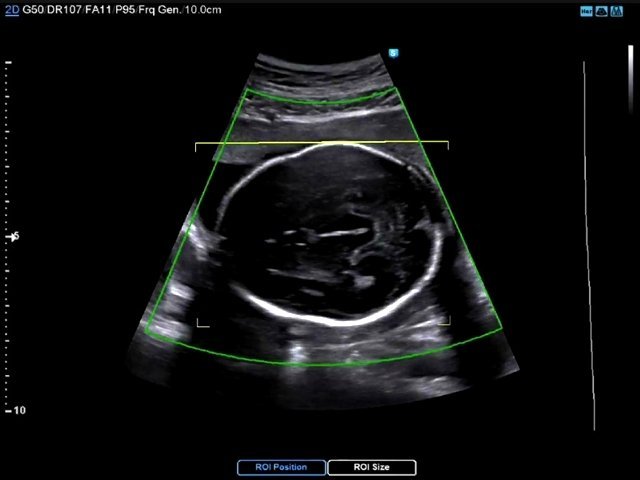 Эхограмма - аксиальное сечение изображения головного мозга плода, где область интереса (ROI) при 3D-сканировании охватывает всю окружность головки