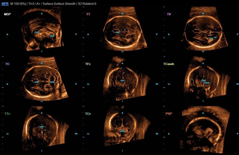 5D CNS - отображение всех диагностически значимых плоскостей головного мозга плода