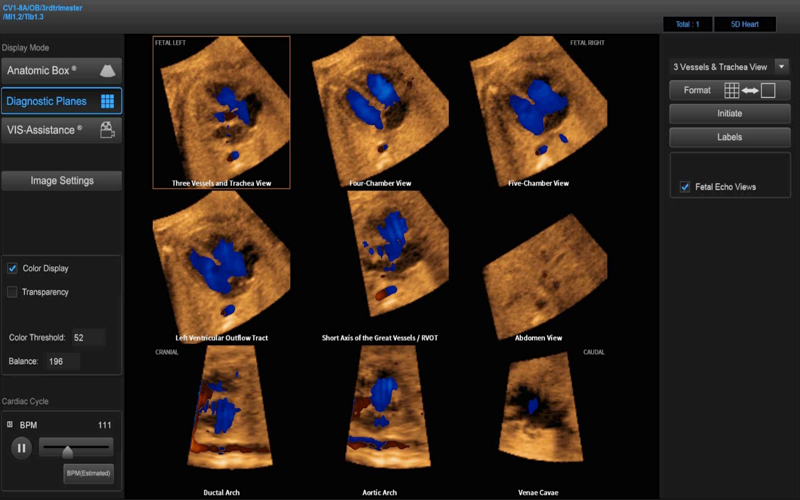 Программа 5D Fetal Heart Color (эхокардиография плода) - 9 стандартных плоскостей