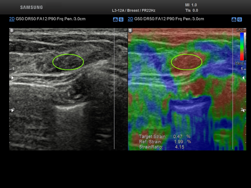 E-Breast - эластография молочной железы