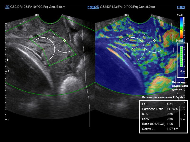 E-Cervix - эластография шейки матки