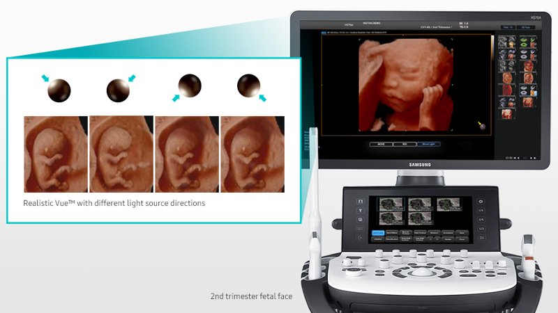 Fetal Realistic Vue - реалистичное 3D УЗИ плода