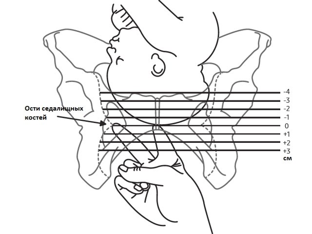 Схема - измерение позиции головки плода методом влагалищного исследования