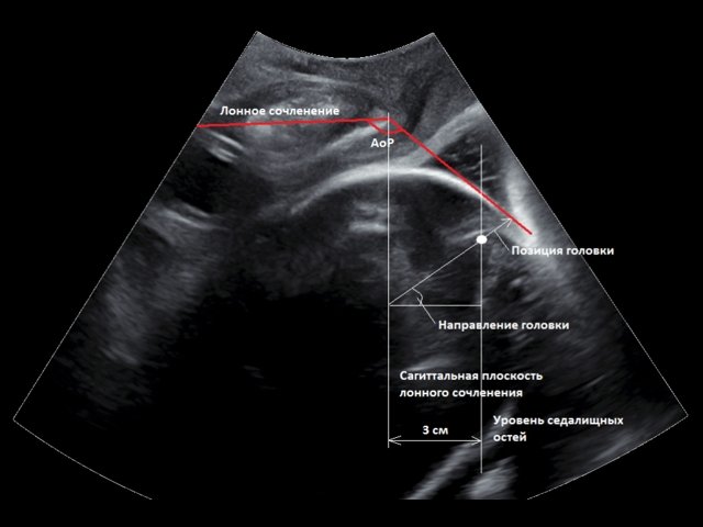 Эхограмма - измерения в срединно-сагиттальной плоскости во время транспериниального УЗИ в родах