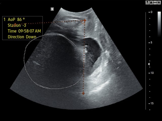 Эхограмма - LaborAssist в сложных случаях визуализации (а)
