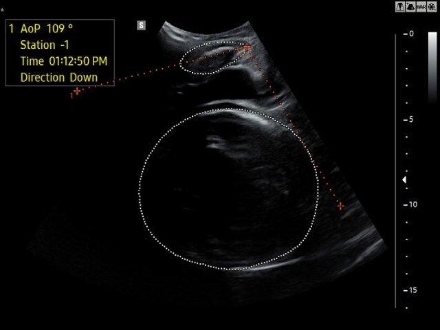 Эхограмма - LaborAssist в сложных случаях визуализации (б)