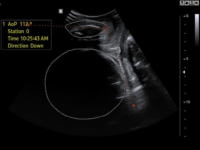 Эхограмма - LaborAssist в сложных случаях визуализации (в)