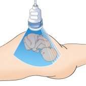 Объемный конвексный датчик - абдоминальное трехмерное УЗИ плода