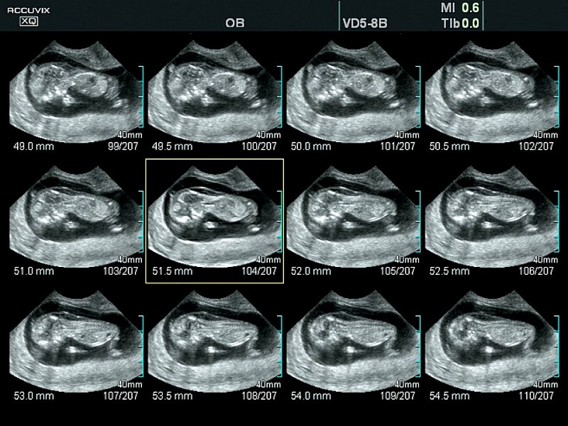 Шейная складка плода в режиме MSV