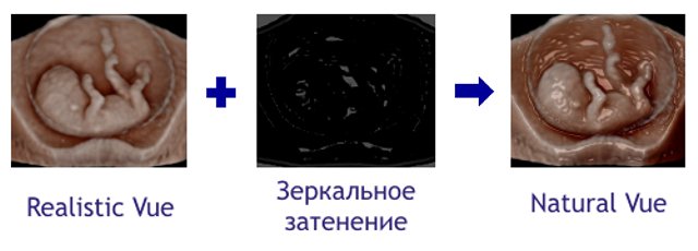 Natural Vue -  реконструкция 3D УЗИ по типу виртуальной амниоскопии