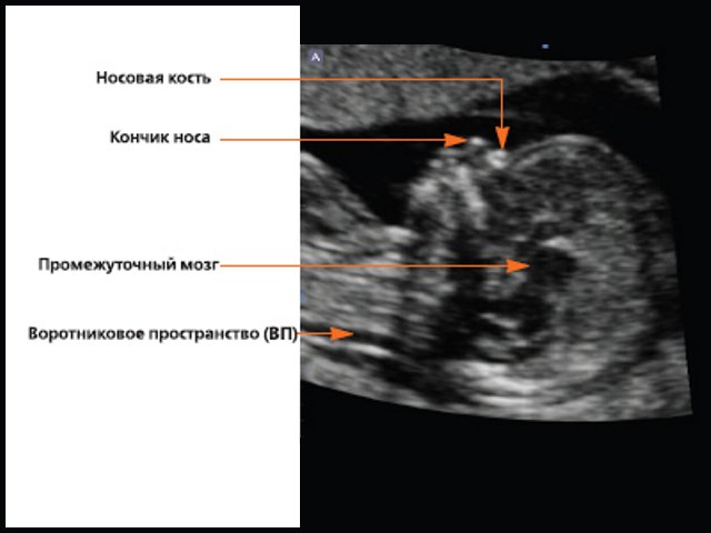 Анатомические ориентиры на изображении плода в срединно-сагиттальной плоскости