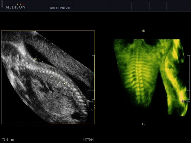 Позвоночник плода в режиме OVIX
