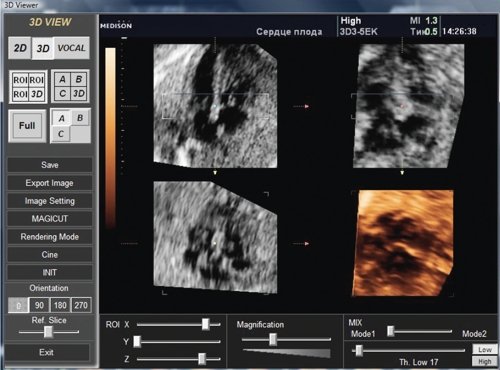 STIC - изображение сердца плода в мультиплановом режиме и трехмерная поверхностная реконструкция на уровне предсердно-желудочковых клапанов