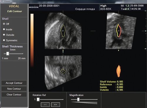 STIC - измерение объема желудочка сердца плода с помощью VOCAL