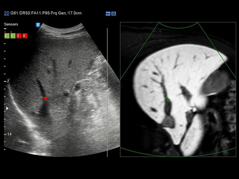 S-Fusion - ультразвуковое исследование печени дополняется данными МРТ