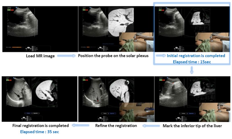 S-Fusion Auto Positioning Registration - последовательность действий в режиме автоматической синхронизации данных УЗИ и МРТ