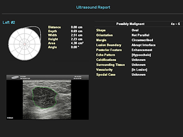 S-Detect Breast - результаты автоматического анализа образования в молочной железе