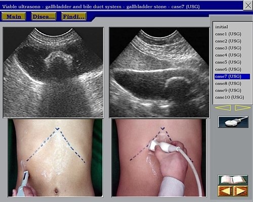 SonoAtlas - расположение ультразвуковых датчиков при исследовании желчного пузыря