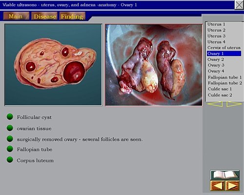 SonoAtlas - схематическое изображение яичников и патоморфический препарат