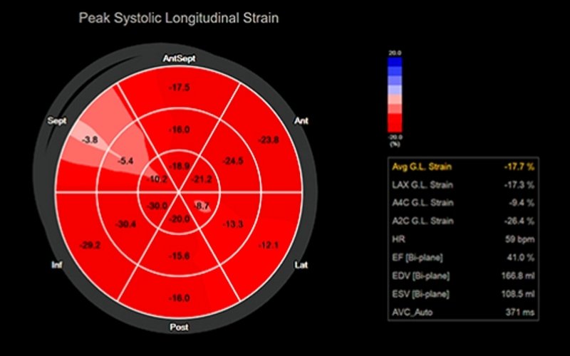 Программа Strain+ - диаграмма «Бычий глаз»