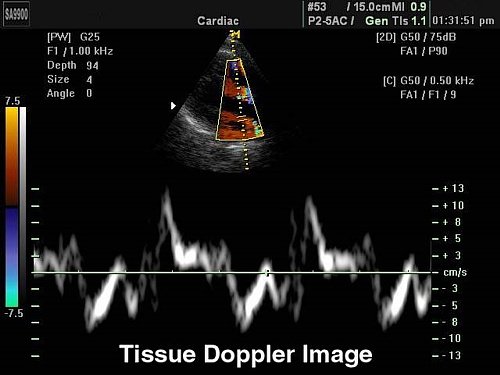 Тканевой допплер (tissue velocity imaging)