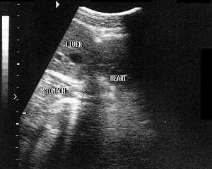Нормальный пищевод и желудок на сагиттальном скене, проходящем через пищеводное отверстие диафрагмы