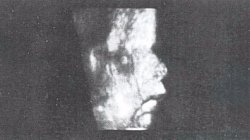 Трисомия 13 - изображение лицевого диморфизма и гипоплазии орбиты у плода (28 недель)