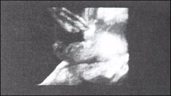 Изображение небольшого омфалоцеле (вид слева, 23 недели).