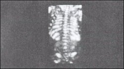 Позвоночник и ребра плода (вид со спины) в транспарантной технике (20 недель)