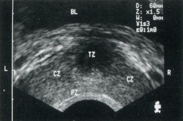 ТРУЗИ предстательной железы - норма (поперечная сканограмма)