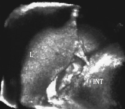 Трехмерное изображение поверхности печени (L) и взаимоотношения петель кишки (INT)