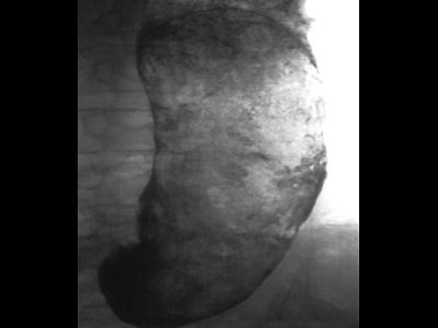 Рентгенограмма безоара желудка