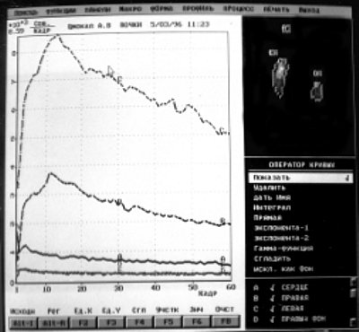 Динамическая сцинтиграфия: дистопия почки и снижение выведения радиофармпрепарата