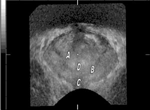 Предстательная железа во фронтальной плоскости