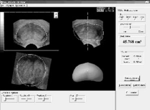 Автоматическое вычисление объема предстательной железы