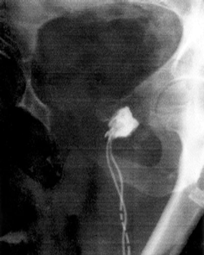 Рентгенограмма простаты с абсцессом