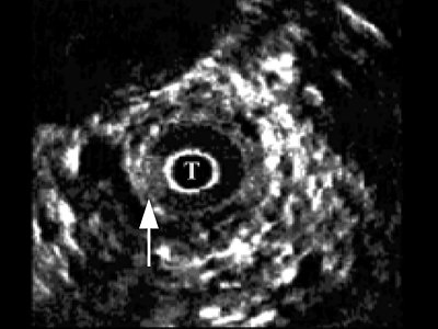 УЗИ: эхограмма папиллярной опухоли мочеточника Т1 (стрелка)