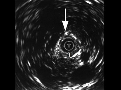 УЗИ: эхограмма нормального мочеточника и парауретеральных тканей (1 - стенка мочеточника, стрелка - адвентиция)