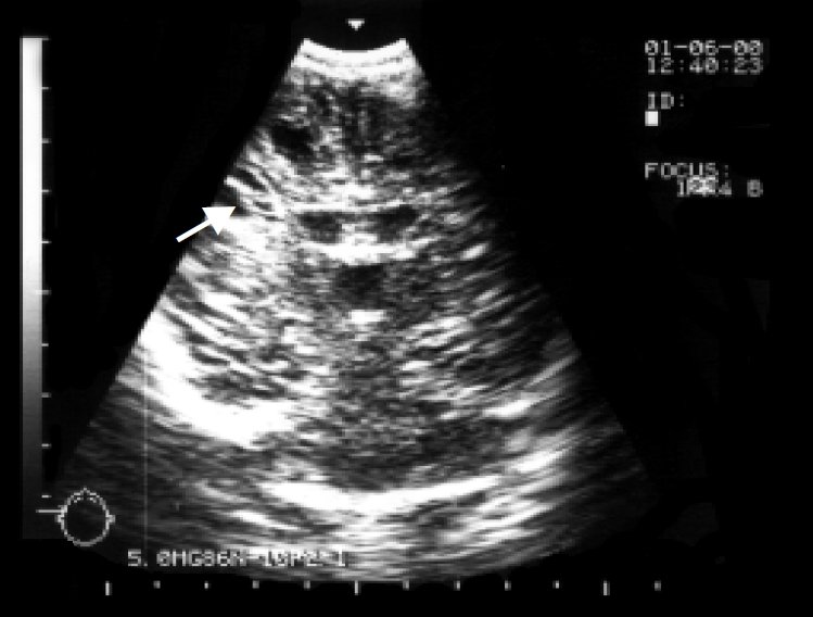 Киста сосудистой сплетений мозга плода. Субэпендимальная киста на УЗИ. Полость Верге у новорожденного на УЗИ. Ультразвуковая анатомия головного мозга плода.