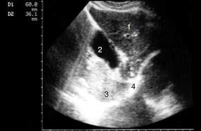 Эхографическая картина левой доли печени аутозита (1); желудка (2); печени паразита (3); общей глиссоновой капсулы (4)