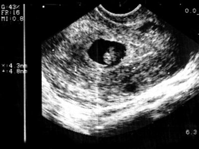 УЗИ: беременность 8-9 недель, гипоплазия хориона