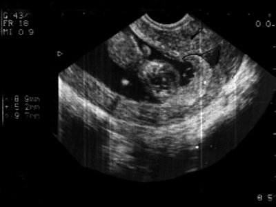 УЗИ: беременность 10 недель, предлежание хориона
