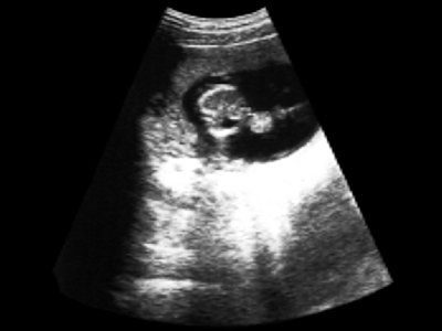 УЗИ: беременность 12 недель, гастрошизис