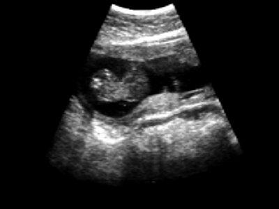 УЗИ: беременность 13 недель, омфалоцеле