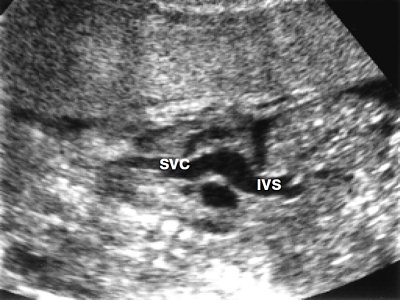 УЗИ: дилатация нижней (IVC) и верхней (SVC) полых вен при антенатальном закрытии овального окна