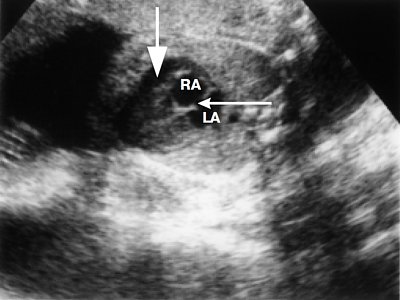УЗИ: четырехкамерное сечение сердца, увеличение правого предсердия