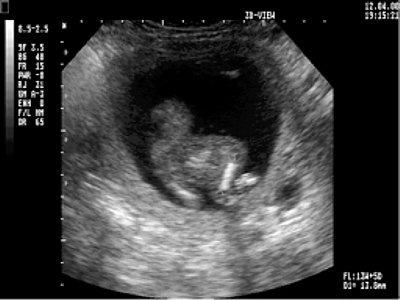 УЗИ: бедро плода нормальной длины для данного срока беременности (B-режим)