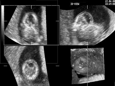 УЗИ: патология формы плода в виде отсутствия четкого разделения между головой и телом (3D-режим)