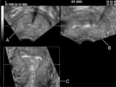 Трехмерное УЗИ матки и внутриматочного средства на основе левоноргестрела (мультиплановая форма)